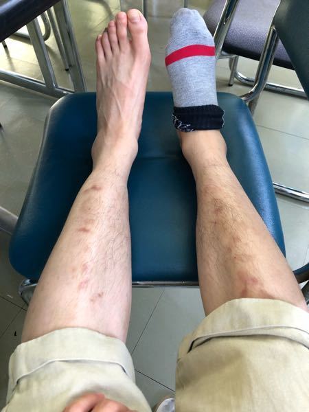 なぜか片足だけ浮腫んでいます 最近バイトでよく立ち仕事をするの Yahoo 知恵袋