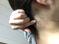 うなじのしこり2週間前位からうなじのしこり 最初はbb弾くらいの大きさ が押す Yahoo 知恵袋