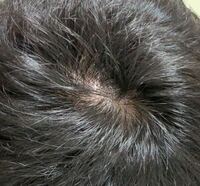 最近歩く時に つむじ付近の髪が浮いて つむじ付近に違和感を覚えます これってい Yahoo 知恵袋