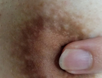 画像あり 閲覧注意 両胸の乳輪に0 05mmぐらいの白い小さいブツブツが大量 Yahoo 知恵袋