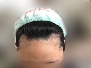 23女です生え際後退してますよね ヘアバンドなどで ぐいっと上げると Yahoo 知恵袋