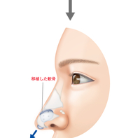 鼻が上向きの人はどうやったら下向きの綺麗な鼻になるんですかね Yahoo 知恵袋