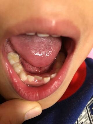 子供の歯に質問です 6歳の息子が最近乳歯が抜けて永久歯が生えてきました Yahoo 知恵袋