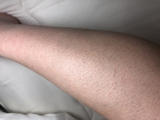 この足女です 足の毛の処理をしすぎて色素沈着と皮膚の引っ張り でぶつぶつ 鳥 Yahoo 知恵袋
