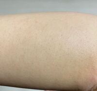 埋没毛なんでしょうか ケノンを使ったら皮膚の中に黒い点々が出来 Yahoo 知恵袋