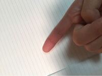 人差し指の第一関節に白いできものが出来たのですが 何か分かる方いますか Yahoo 知恵袋