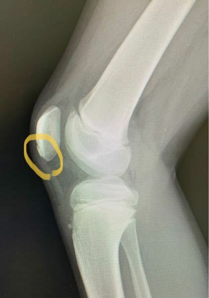 膝蓋骨骨折してませんか レントゲン写真 黄色丸の部分です 素人目にはヒビ Yahoo 知恵袋