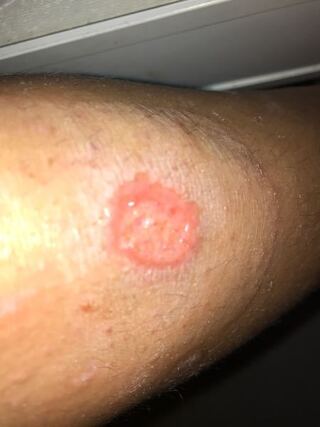 はがす キズパワーパッド