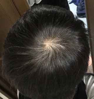 育毛剤について質問です 今チャップアップという育毛剤を使用しているのですが 育 Yahoo 知恵袋