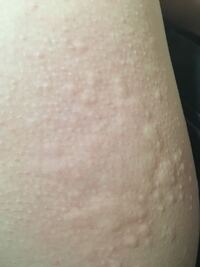 内ももがかゆいです 触った感じポツポツしてたので見てみたらこうな Yahoo 知恵袋