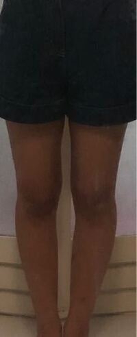 効果的に簡単にo脚を治す方法はありますか 今までo脚ではなかったの Yahoo 知恵袋