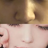 鼻の横の線を消したいです この鼻の横の線は 整形でどうにかなるものでしょう Yahoo 知恵袋