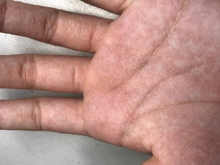 閲覧注意ですほんの4日ほど前から両手 両腕 両足 両肩に小さい水疱のようなもの Yahoo 知恵袋