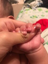 子供の指がこのように腫れて白くなってるのですが これ化膿してるのでしょうか Yahoo 知恵袋