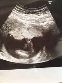 15週でお尻を下から見たエコーです この状態で突起物が見えなければ ほぼ Yahoo 知恵袋