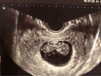 検診から帰宅しエコー写真をみて気になったので質問させていただきます 10 Yahoo 知恵袋