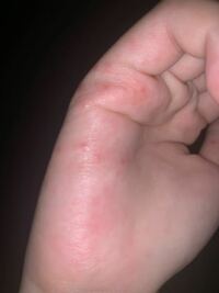 指の湿疹についてです 指の関節周辺を中心い痛痒い大きめの湿疹が数個で Yahoo 知恵袋