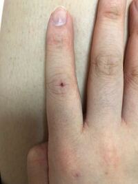 心当たりがない血豆みたいなのはただの血豆ですか 血豆は そんな腫れ方しな Yahoo 知恵袋