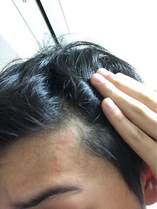 髪の毛あげてとってます なんとなく生え際が薄い気がします ｍ字になっ Yahoo 知恵袋