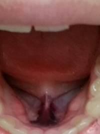 口の中に出来ていて 黒い口内炎っぽいやつです 舌で触るとほんの少しの痛みを感じ Yahoo 知恵袋