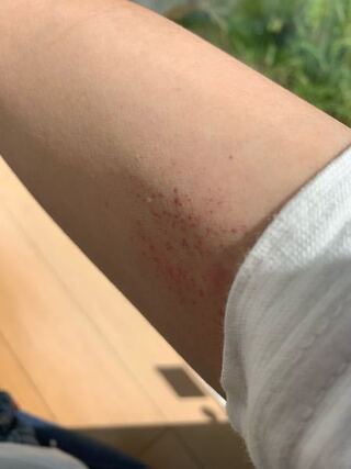 高1です 脇の下にぶつぶつができました とてもかゆいです 何なんでしょう Yahoo 知恵袋