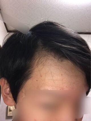 髪あげてかっこよくしたいんですけど 結構禿げてます 笑 どのよ Yahoo 知恵袋