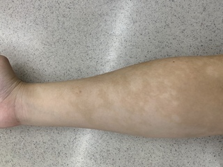 皮膚のまだら模様 みたいなものについてです ひと月くらい前から腕にと Yahoo 知恵袋