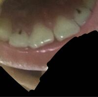 前歯の横の歯の裏側に黒い線のようなものがありました 右側が痛くなって鏡で Yahoo 知恵袋