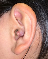 中 でき の もの 耳 耳や耳の中にできた出来物ってニキビ？原因や対処法を解説！