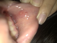 下唇の裏に白いできものができたのですが 何かわかる人いませんか 自然に治るもの Yahoo 知恵袋