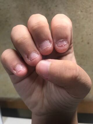 こちらは私の手なのですが 爪や周りの皮を食べてしまう癖があり何年も解 Yahoo 知恵袋