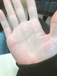 2年ほど前から手のひらが赤いです 肝臓の病気かとも思ったのですが昨年別件で受け Yahoo 知恵袋