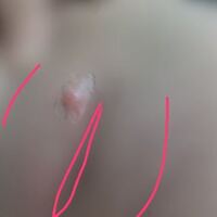 おまたに大きなニキビのようなできものが昨日からあります なにが原因でしょ Yahoo 知恵袋