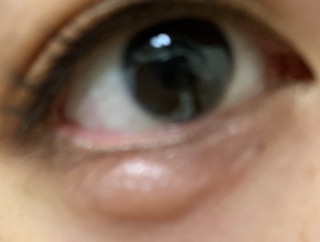 たまに 右目の涙袋だけ腫れます 蚊に刺されたかのような 触ってないし目に違和感 Yahoo 知恵袋