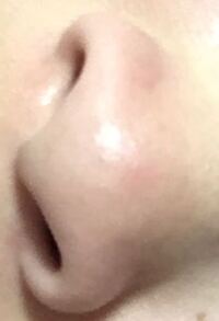 鼻の真ん中が腫れています さわるとでこぼこしていて優しくちょんっとしても痛いで Yahoo 知恵袋