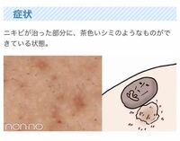 ニキビ シミについて質問です 僕は今高校生なのですが 潰してしまったり Yahoo 知恵袋