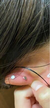 軟骨にピアスを開けたのですが軟骨部分が白い皮の様なものが出来て後ろがプクッ Yahoo 知恵袋