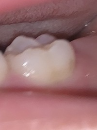 4歳娘の奥歯 灰色の影がありますが 虫歯でしょうか 歯科医師 Yahoo 知恵袋