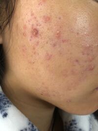 顔を洗わなかったらどうなりますか 22の女です 三年前に鼻を整 Yahoo 知恵袋
