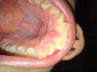 口の中の上の部分が血の味がして 痛いです これはなんなんでしょうか Yahoo 知恵袋