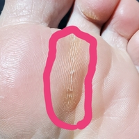 足の裏の痛み足を地面に着いた時 丸で囲った場所が痛いです 白っぽくなっている皮 Yahoo 知恵袋