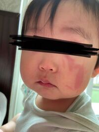 子供が瞼をイスにぶつけて 腫れて目尻の横を切ってしまいました 何科に行けばよ Yahoo 知恵袋