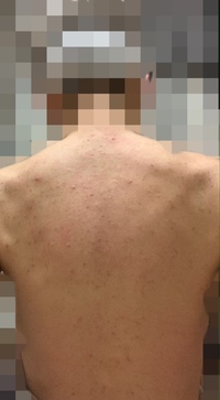 汚い写真 失礼します 中一の頃から背中ニキビに悩んでいます 色々な薬 Yahoo 知恵袋