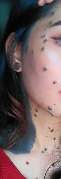 このホクロ全部除去したらいくらかかりますか 生え際から首の大きい痣 Yahoo 知恵袋