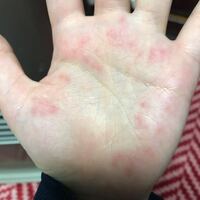 このような斑点ってアレルギーかなにかですか 今日手がチクチクするなと思 Yahoo 知恵袋