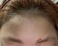 昨日眉脱色をしたら皮膚が赤くなってヒリヒリしてます 軟膏を塗って処置した Yahoo 知恵袋