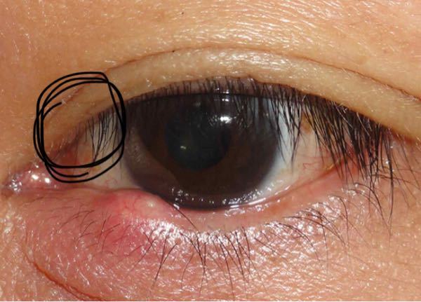 ものもらいは目頭にも出来ますか？今までに、上まぶた・下まぶたがものもらいに&hellip; Yahoo!知恵袋