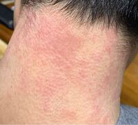 閲覧注意 首がとても痛くて動かせません この湿疹は何でしょうか 痒み Yahoo 知恵袋