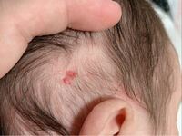新生児の赤いあざのような斑点について 今年の１月３日 Yahoo 知恵袋
