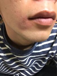 ニベアを使ったら赤くなり痒みが出てきました 先日スノボードに行ったせいか Yahoo 知恵袋